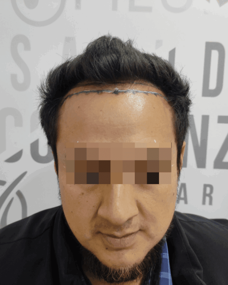 ANTES