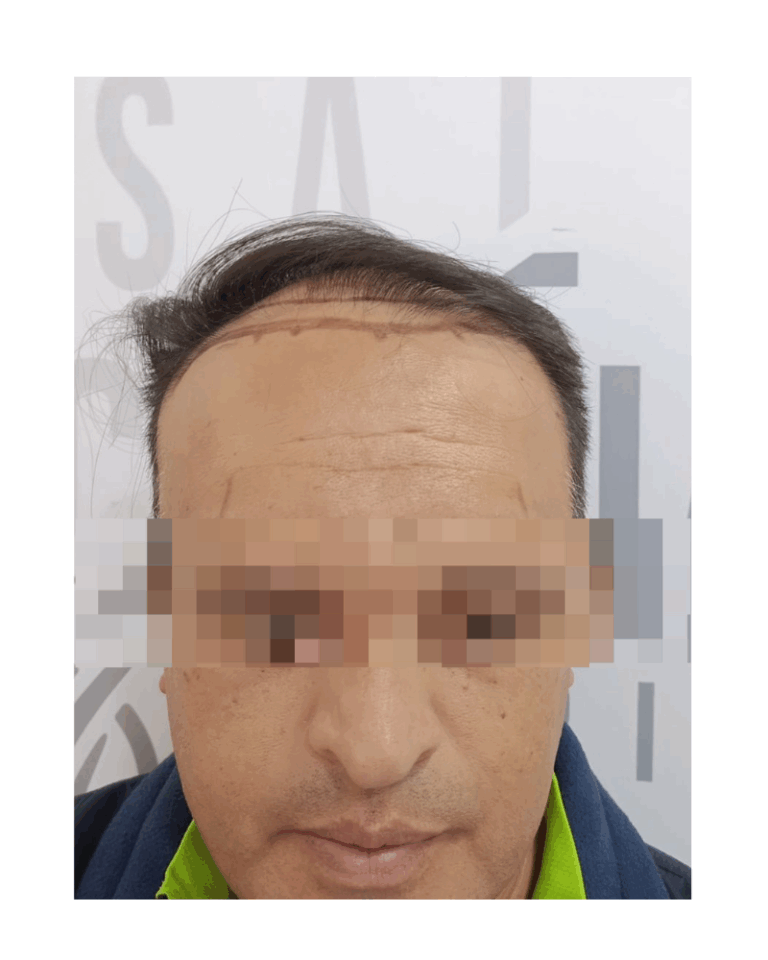 ANTES