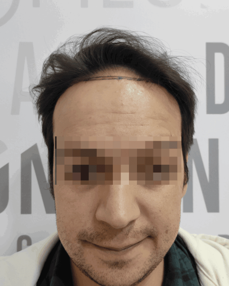 ANTES
